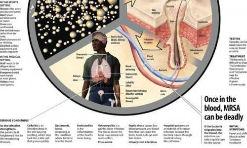 How a Lethal Bacteria Kills Infographic