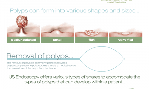 Polypectomy the stats, facts and tools infographic
